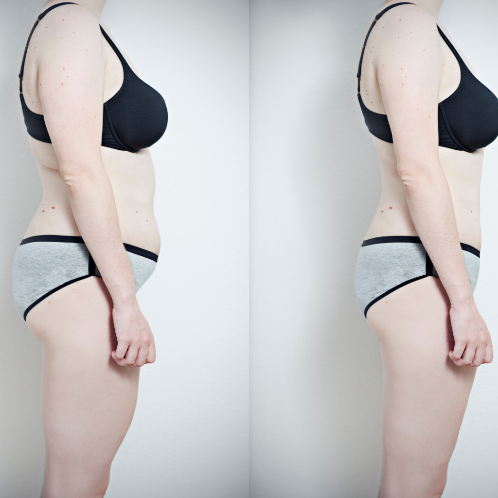 before and after medical weight loss